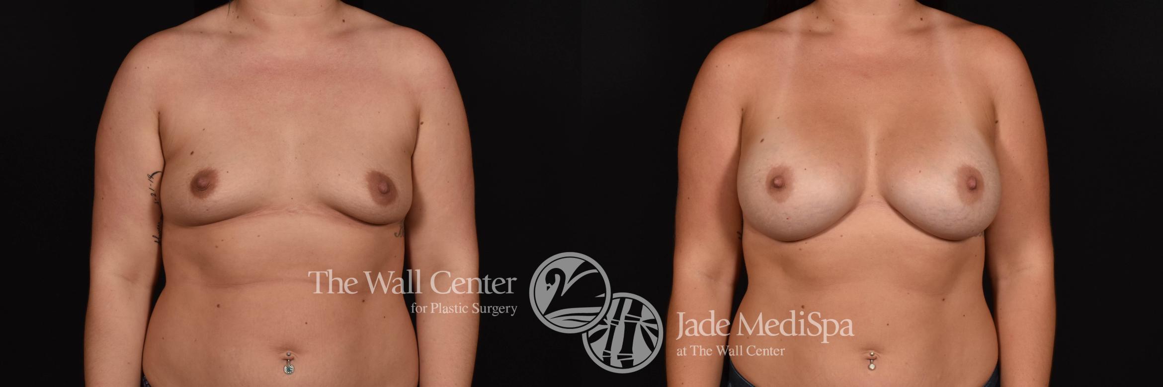 Breast Augmentation with SAFELipo Front Photo, Shreveport, Louisiana, The Wall Center for Plastic Surgery, Case 847