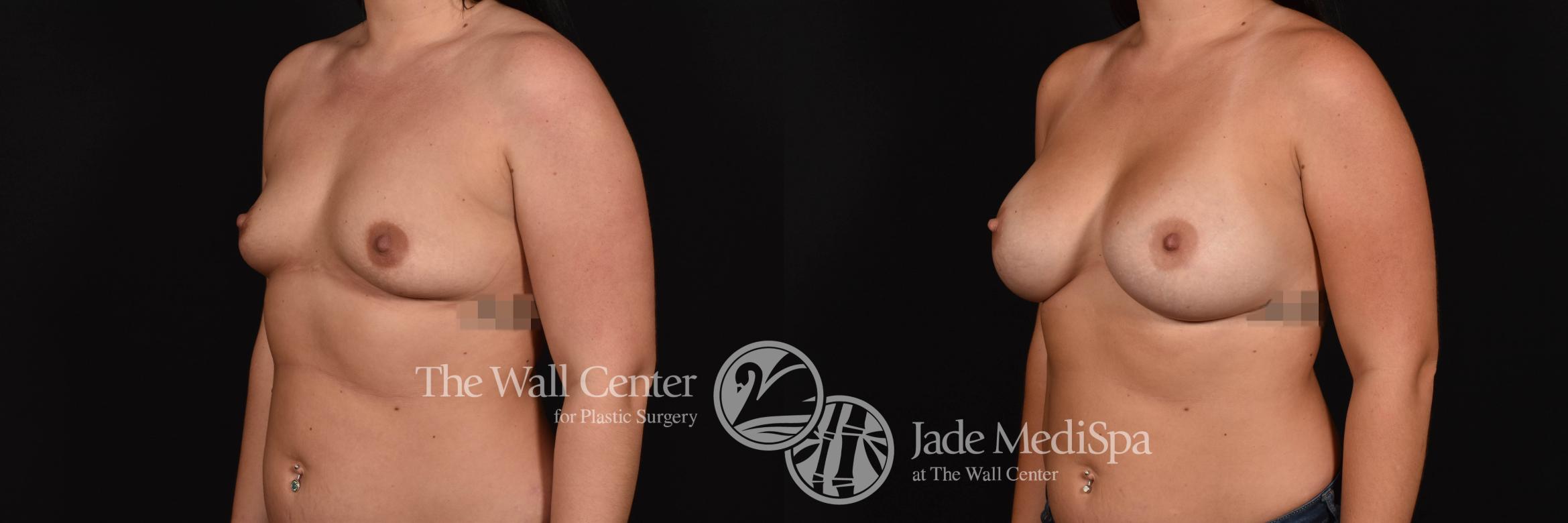 Breast Augmentation with SAFELipo Left Oblique Photo, Shreveport, Louisiana, The Wall Center for Plastic Surgery, Case 847