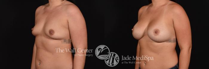 Breast Augmentation with SAFELipo Left Oblique Photo, Shreveport, Louisiana, The Wall Center for Plastic Surgery, Case 847