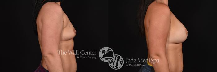 Breast Augmentation with SAFELipo Right Side Photo, Shreveport, Louisiana, The Wall Center for Plastic Surgery, Case 847