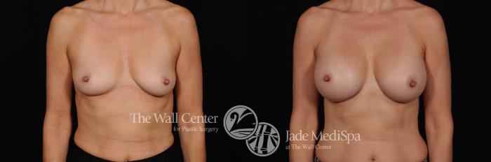 Breast Augmentation Front Photo, Shreveport, Louisiana, The Wall Center for Plastic Surgery, Case 849