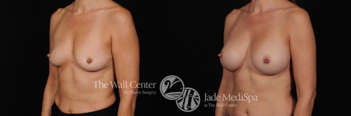 Breast Augmentation Left Oblique Photo, Shreveport, Louisiana, The Wall Center for Plastic Surgery, Case 849