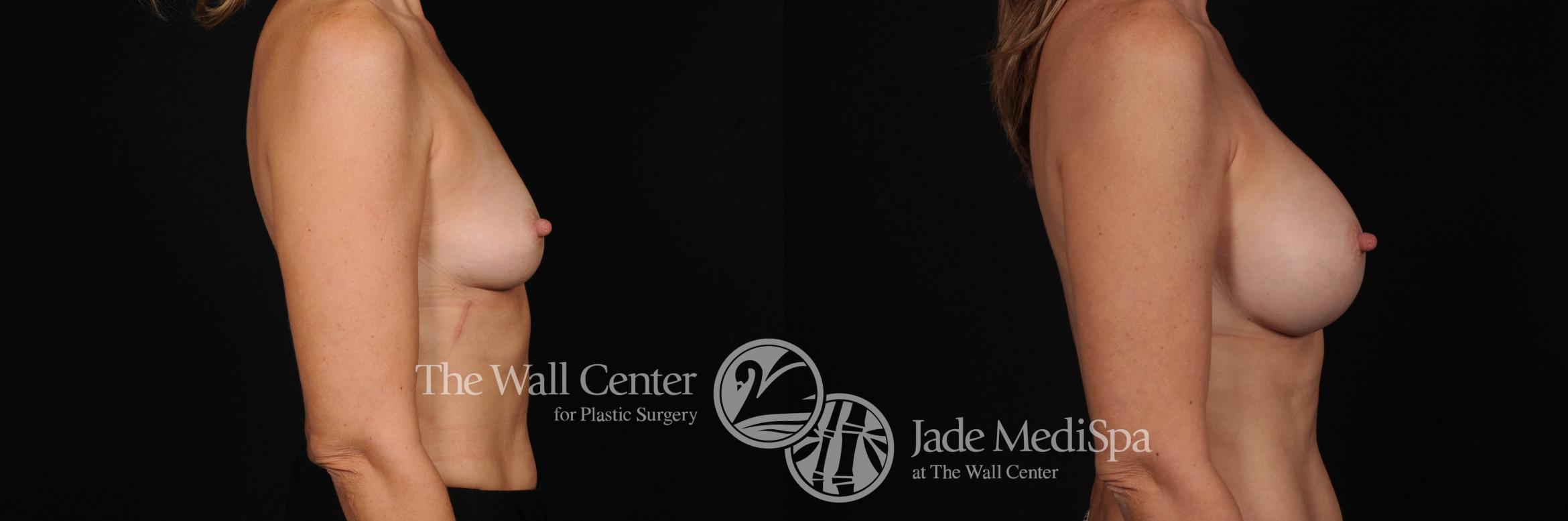 Breast Augmentation Right Side Photo, Shreveport, Louisiana, The Wall Center for Plastic Surgery, Case 849