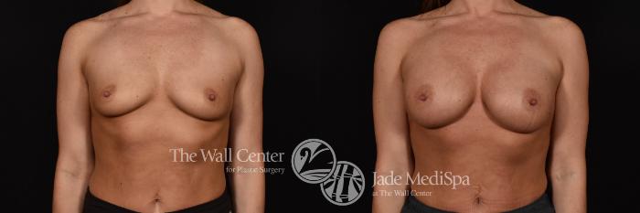 Breast Augmentation Front Photo, Shreveport, Louisiana, The Wall Center for Plastic Surgery, Case 879
