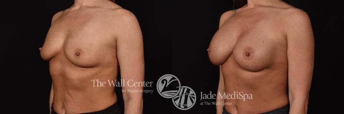 Breast Augmentation Left Oblique Photo, Shreveport, Louisiana, The Wall Center for Plastic Surgery, Case 879