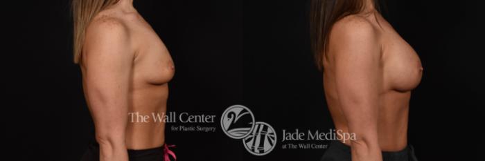Breast Augmentation Right Side Photo, Shreveport, Louisiana, The Wall Center for Plastic Surgery, Case 879