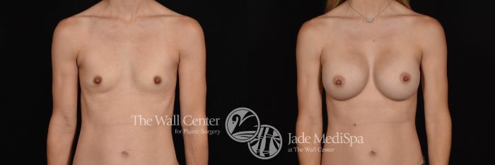 Breast Augmentation Front Photo, Shreveport, Louisiana, The Wall Center for Plastic Surgery, Case 885