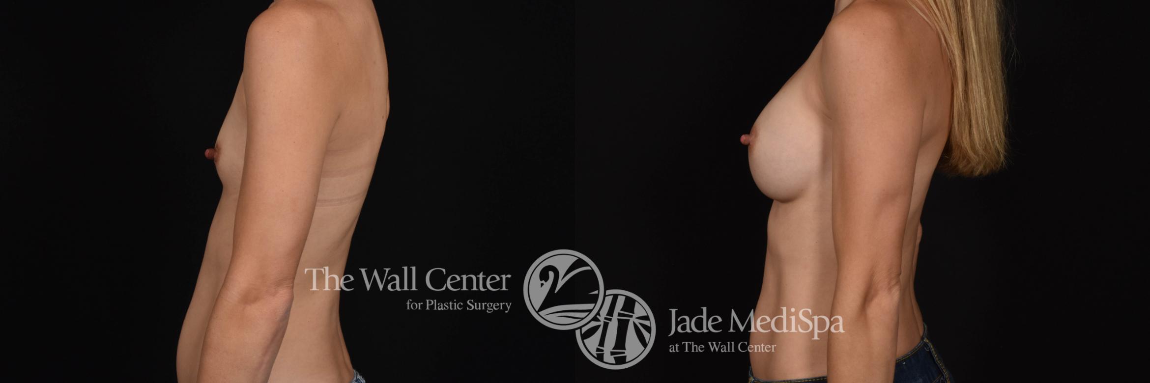 Breast Augmentation Left Side Photo, Shreveport, Louisiana, The Wall Center for Plastic Surgery, Case 885