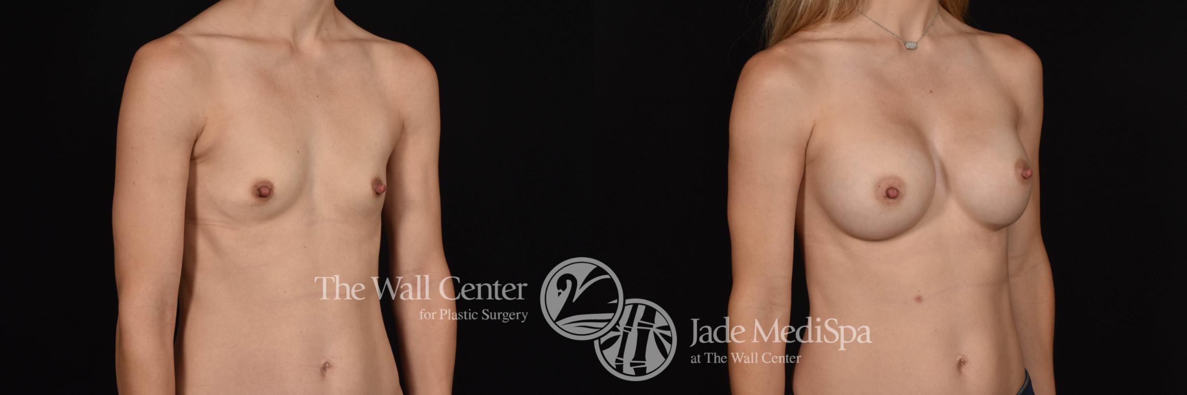 Breast Augmentation Right Oblique Photo, Shreveport, Louisiana, The Wall Center for Plastic Surgery, Case 885