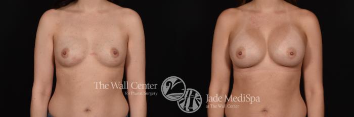 Breast Augmentation Front Photo, Shreveport, Louisiana, The Wall Center for Plastic Surgery, Case 886