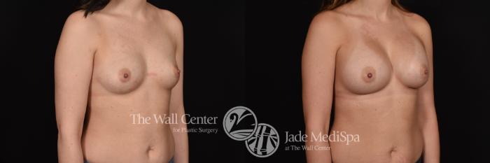Breast Augmentation Right Oblique Photo, Shreveport, Louisiana, The Wall Center for Plastic Surgery, Case 886