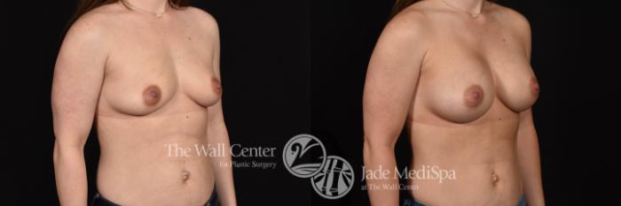 Breast Augmentation Right Oblique Photo, Shreveport, Louisiana, The Wall Center for Plastic Surgery, Case 887