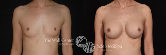 Breast Augmentation Front Photo, Shreveport, Louisiana, The Wall Center for Plastic Surgery, Case 888