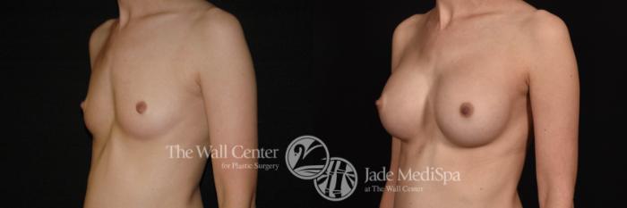 Breast Augmentation Left Oblique Photo, Shreveport, Louisiana, The Wall Center for Plastic Surgery, Case 888