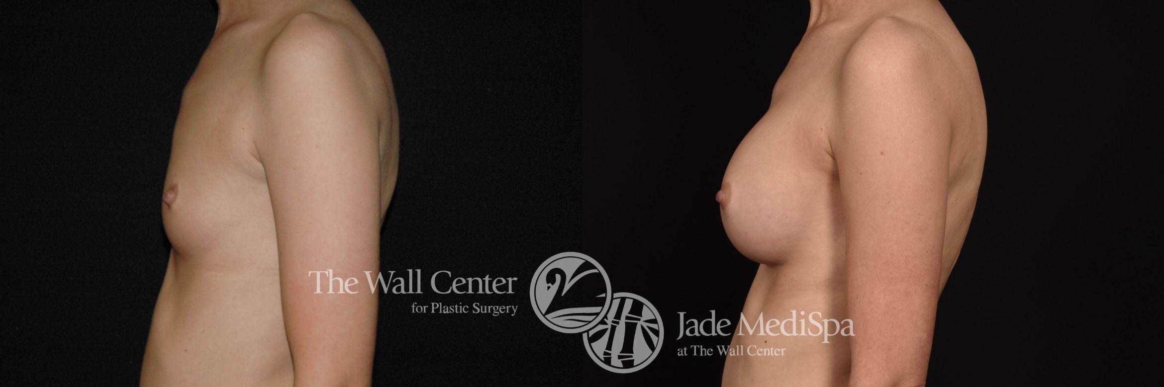 Breast Augmentation Left Side Photo, Shreveport, Louisiana, The Wall Center for Plastic Surgery, Case 888