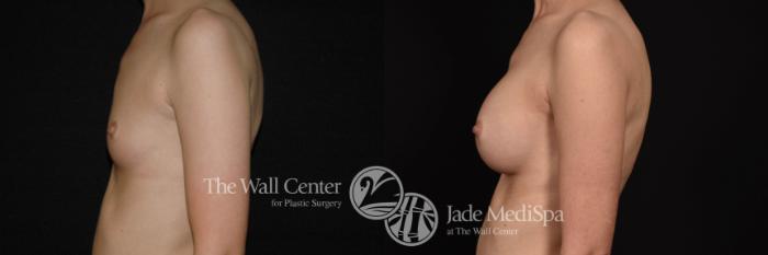 Breast Augmentation Left Side Photo, Shreveport, Louisiana, The Wall Center for Plastic Surgery, Case 888