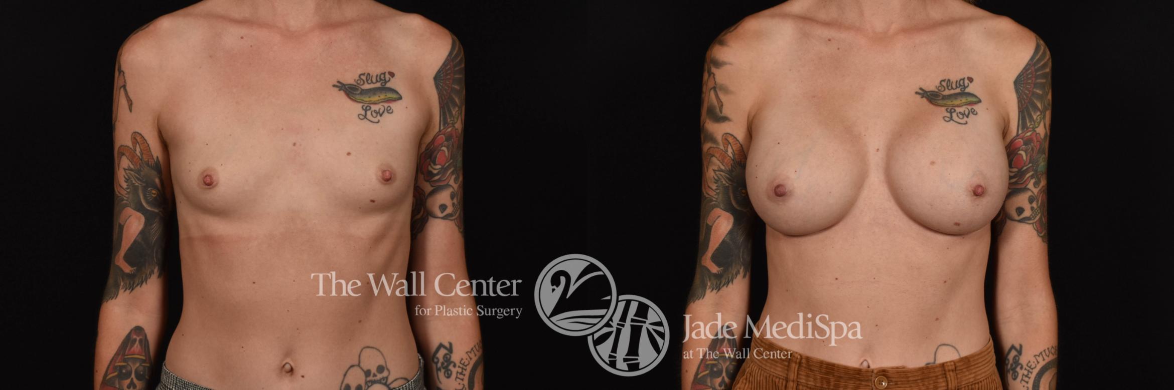 Breast Augmentation Front Photo, Shreveport, Louisiana, The Wall Center for Plastic Surgery, Case 899