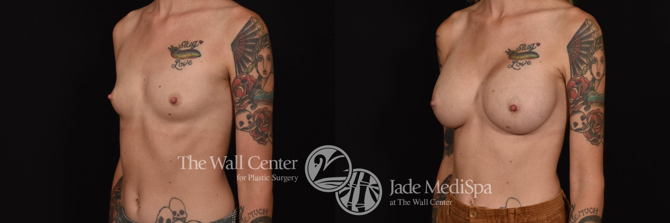 Breast Augmentation Left Oblique Photo, Shreveport, Louisiana, The Wall Center for Plastic Surgery, Case 899