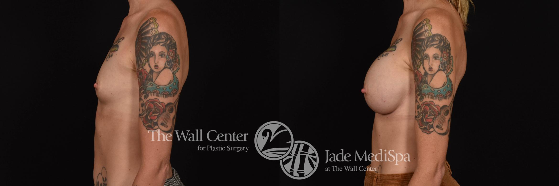 Breast Augmentation Left Side Photo, Shreveport, Louisiana, The Wall Center for Plastic Surgery, Case 899
