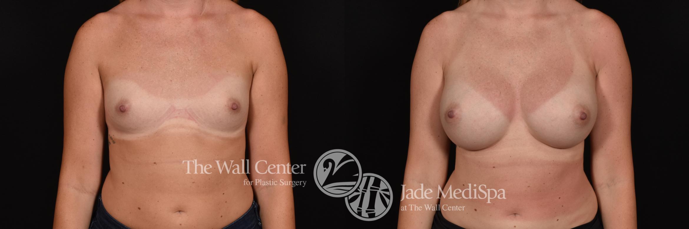 Breast Augmentation Front Photo, Shreveport, Louisiana, The Wall Center for Plastic Surgery, Case 900