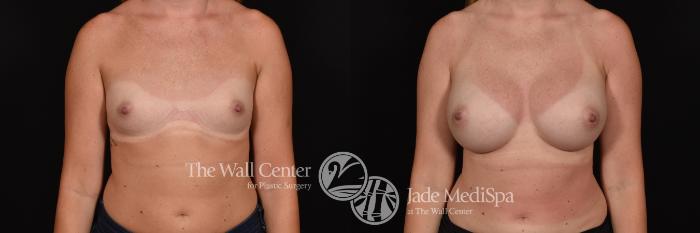 Breast Augmentation Front Photo, Shreveport, Louisiana, The Wall Center for Plastic Surgery, Case 900