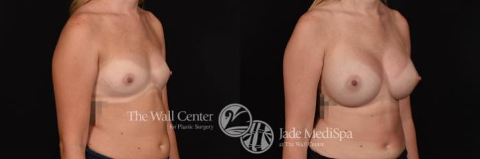 Breast Augmentation Right Oblique Photo, Shreveport, Louisiana, The Wall Center for Plastic Surgery, Case 900