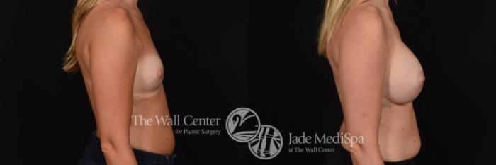 Breast Augmentation Right Side Photo, Shreveport, Louisiana, The Wall Center for Plastic Surgery, Case 900