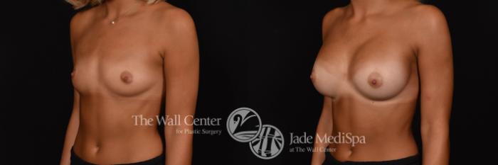 Breast Augmentation Left Oblique Photo, Shreveport, Louisiana, The Wall Center for Plastic Surgery, Case 907