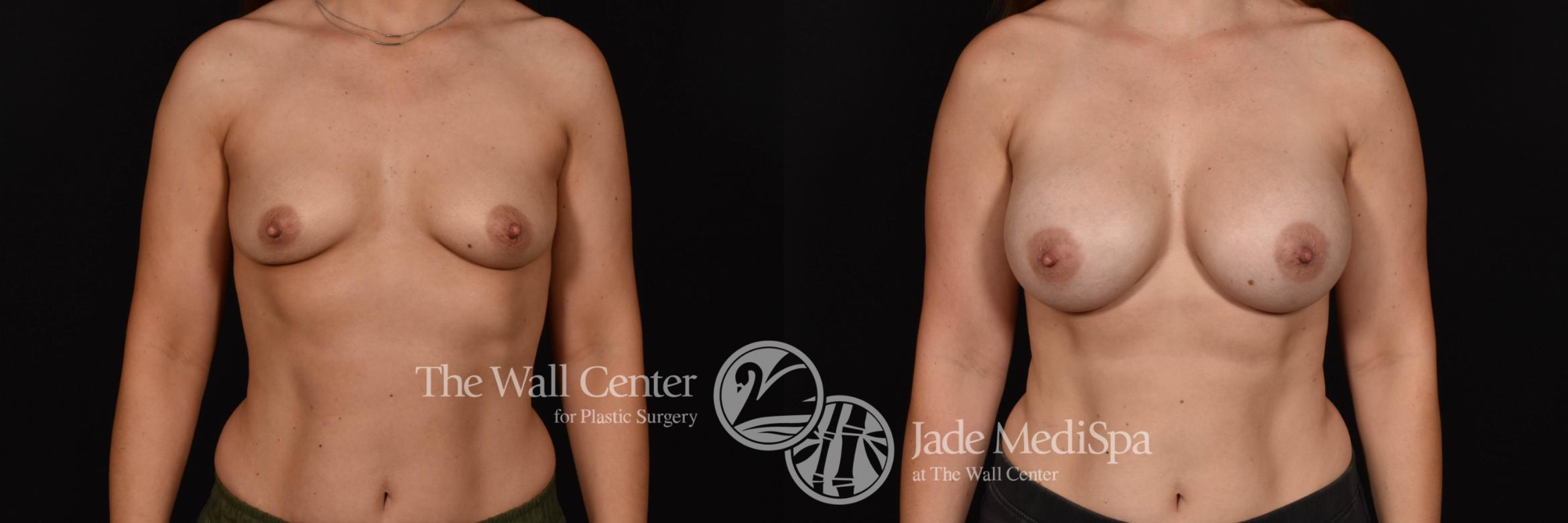 Breast Augmentation Front Photo, Shreveport, Louisiana, The Wall Center for Plastic Surgery, Case 912
