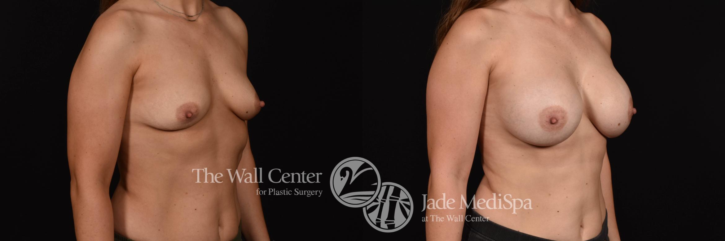 Breast Augmentation Right Oblique Photo, Shreveport, Louisiana, The Wall Center for Plastic Surgery, Case 912