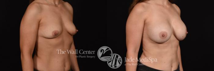 Breast Augmentation Right Oblique Photo, Shreveport, Louisiana, The Wall Center for Plastic Surgery, Case 912