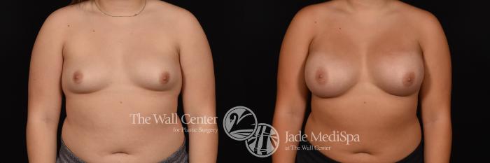 Breast Augmentation Front Photo, Shreveport, Louisiana, The Wall Center for Plastic Surgery, Case 913