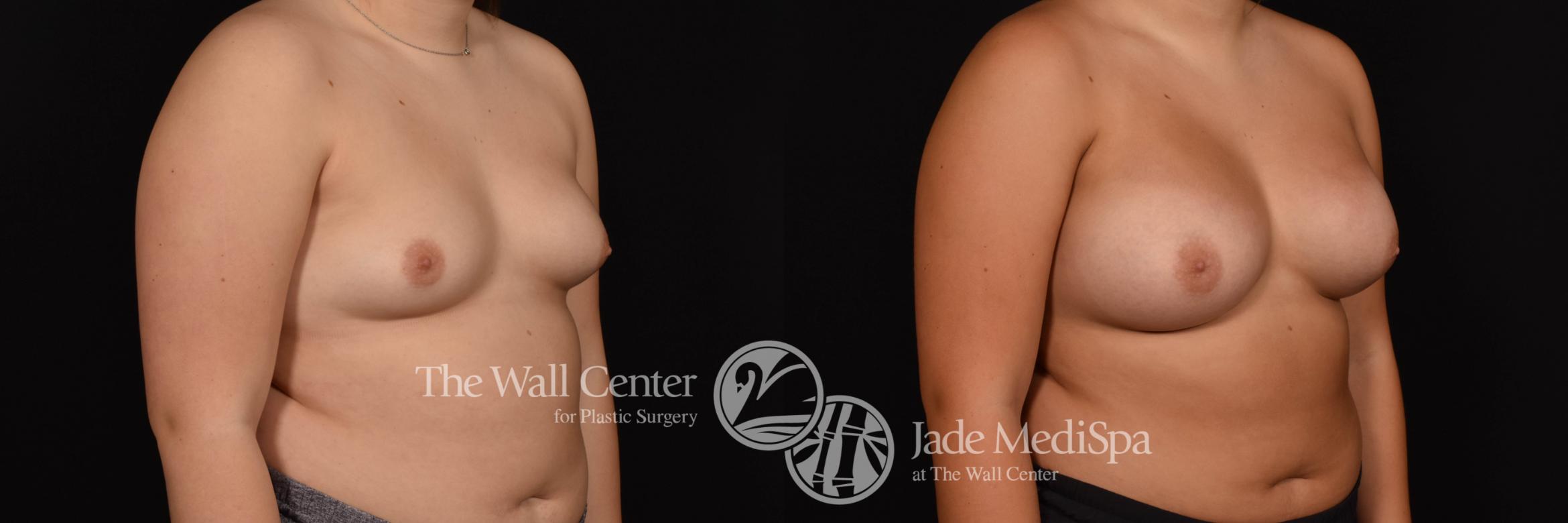 Breast Augmentation Right Oblique Photo, Shreveport, Louisiana, The Wall Center for Plastic Surgery, Case 913