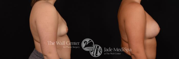 Breast Augmentation Right Side Photo, Shreveport, Louisiana, The Wall Center for Plastic Surgery, Case 913