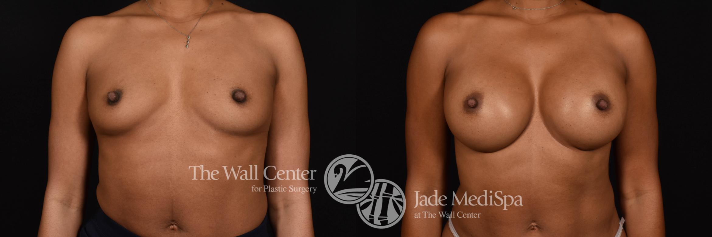 Breast Augmentation Front Photo, Shreveport, Louisiana, The Wall Center for Plastic Surgery, Case 916