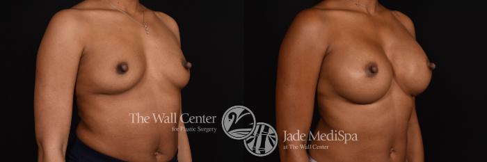 Breast Augmentation Right Oblique Photo, Shreveport, Louisiana, The Wall Center for Plastic Surgery, Case 916