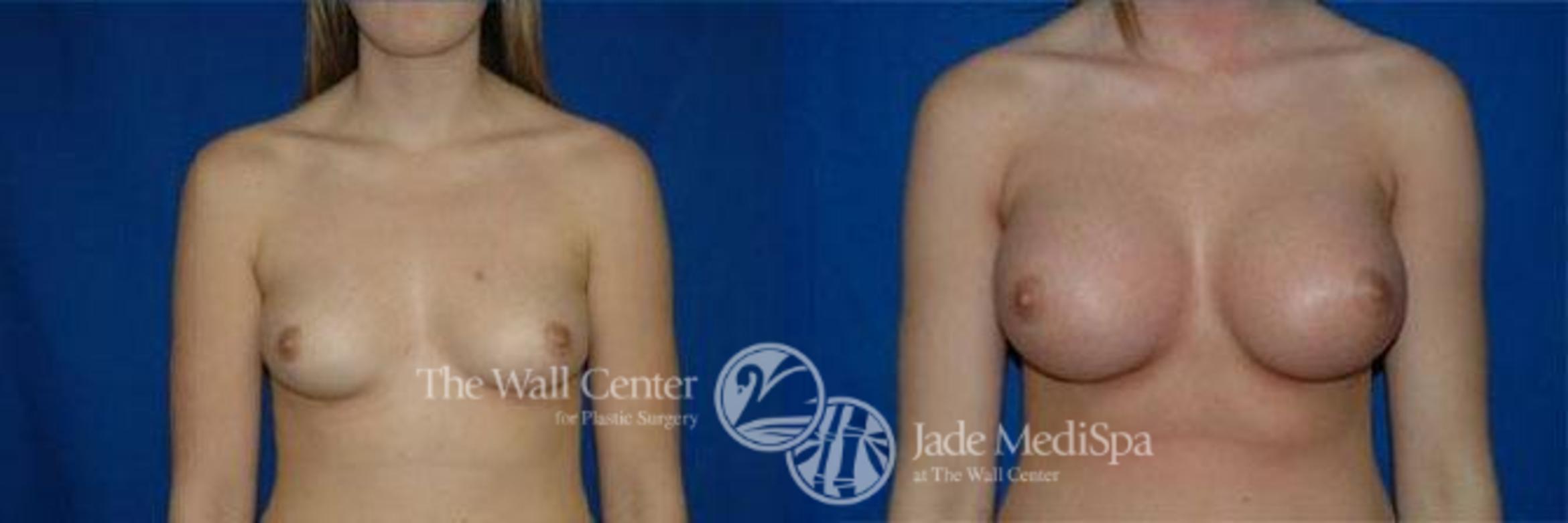 Before & After Breast Augmentation Case 92 View #1 View in Shreveport, LA