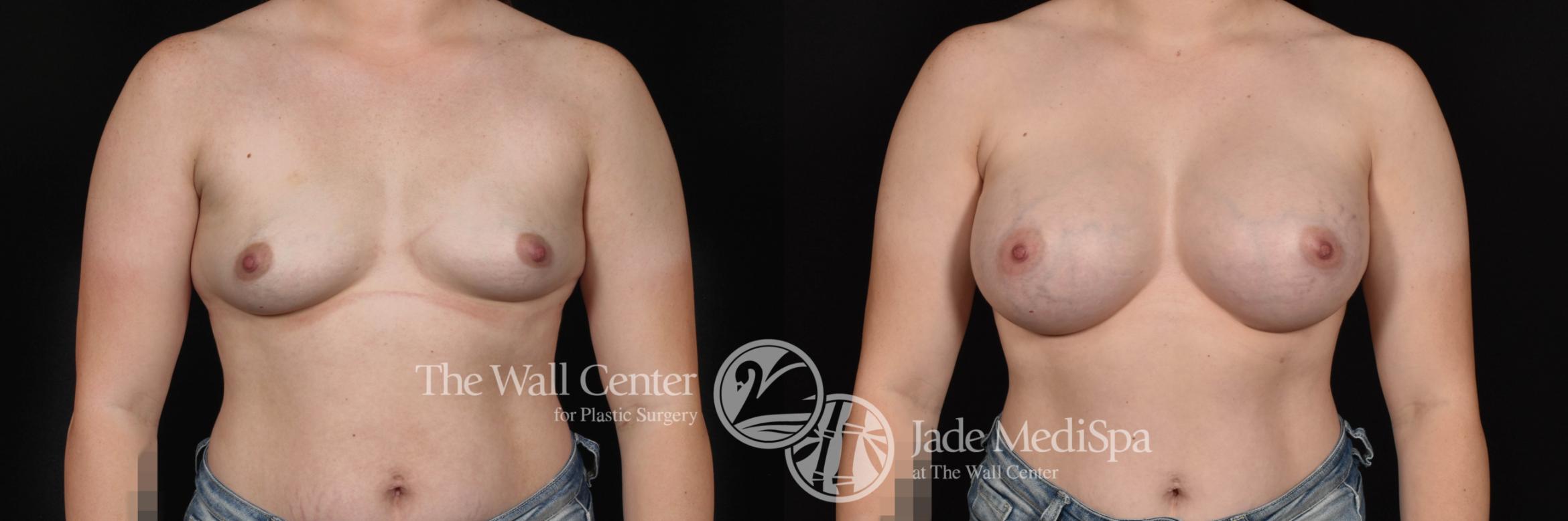 Breast Augmentation Front Photo, Shreveport, Louisiana, The Wall Center for Plastic Surgery, Case 928