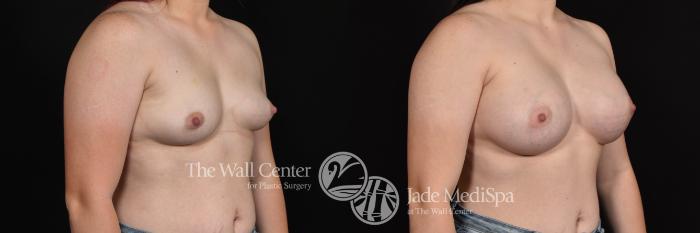 Breast Augmentation Right Oblique Photo, Shreveport, Louisiana, The Wall Center for Plastic Surgery, Case 928