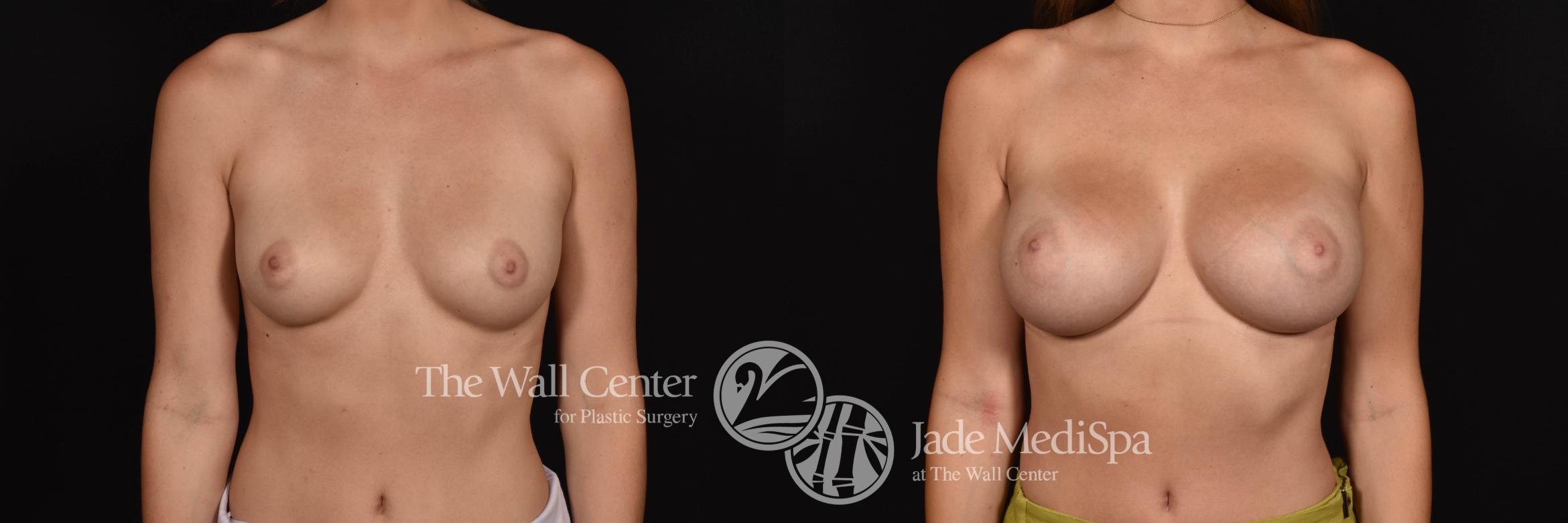 Breast Augmentation Front Photo, Shreveport, Louisiana, The Wall Center for Plastic Surgery, Case 929