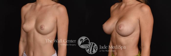 Breast Augmentation Left Oblique Photo, Shreveport, Louisiana, The Wall Center for Plastic Surgery, Case 929