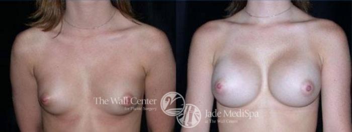 Before & After Breast Augmentation Case 93 View #1 View in Shreveport, LA