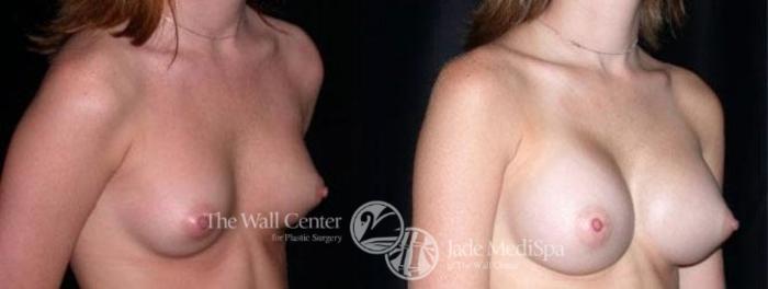 Before & After Breast Augmentation Case 93 View #2 View in Shreveport, LA