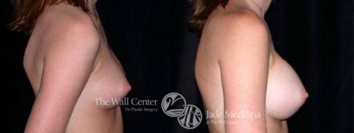 Before & After Breast Augmentation Case 93 View #3 View in Shreveport, LA
