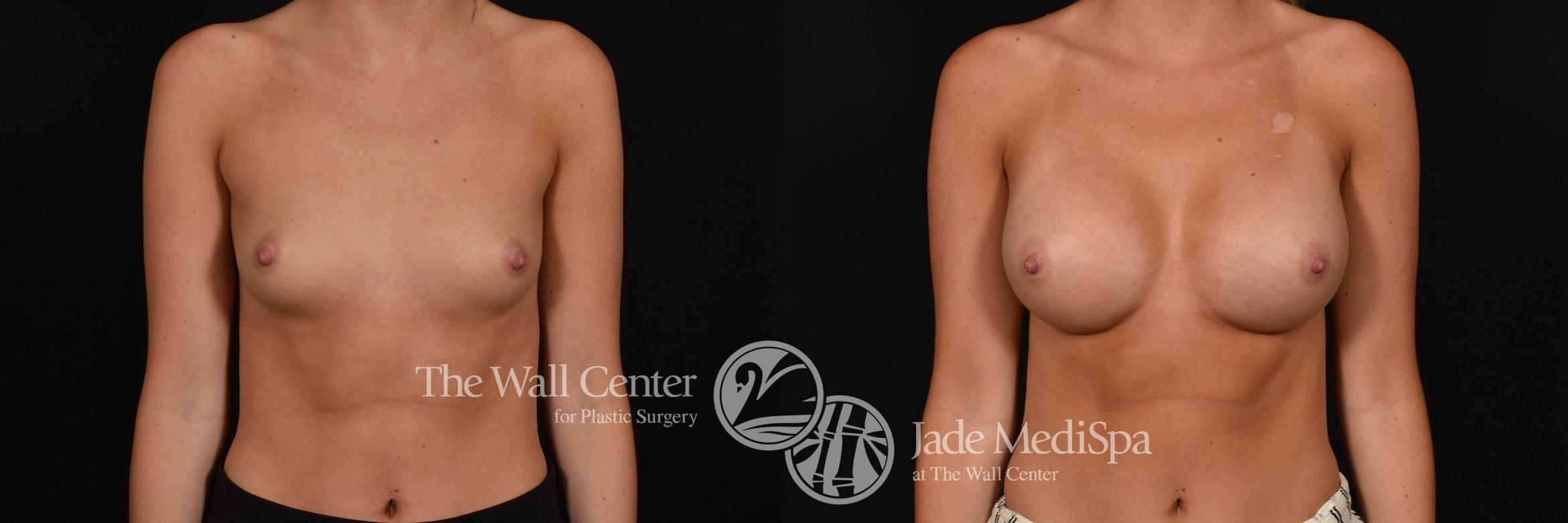 Breast Augmentation Front Photo, Shreveport, Louisiana, The Wall Center for Plastic Surgery, Case 936