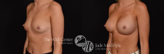 Breast Augmentation Left Oblique Photo, Shreveport, Louisiana, The Wall Center for Plastic Surgery, Case 936