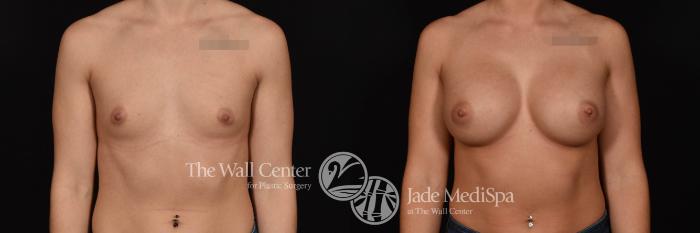 Breast Augmentation Front Photo, Shreveport, Louisiana, The Wall Center for Plastic Surgery, Case 937