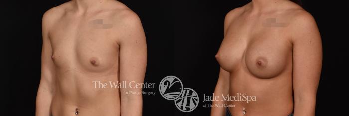 Breast Augmentation Left Oblique Photo, Shreveport, Louisiana, The Wall Center for Plastic Surgery, Case 937