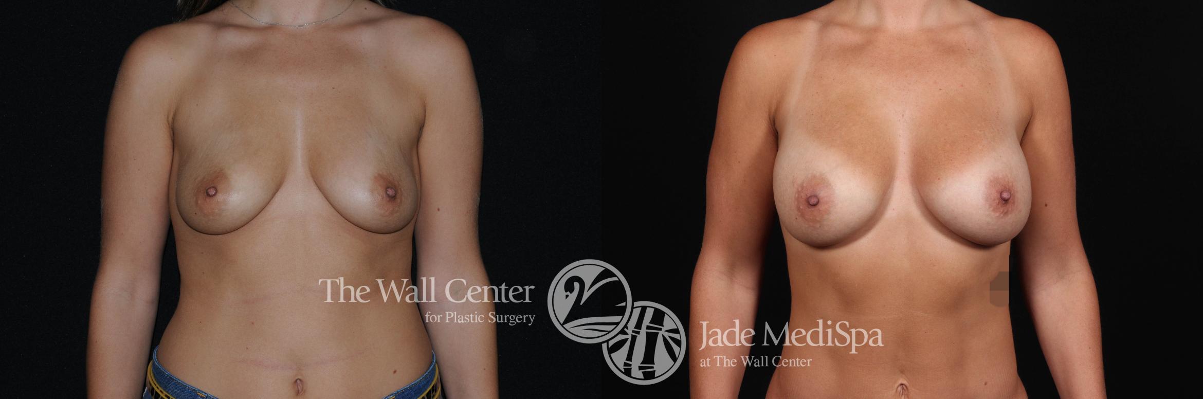 Breast Augmentation Front Photo, Shreveport, Louisiana, The Wall Center for Plastic Surgery, Case 939