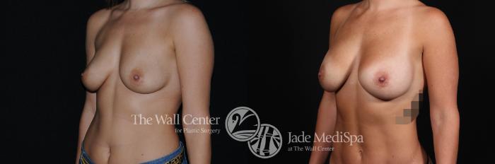 Breast Augmentation Left Oblique Photo, Shreveport, Louisiana, The Wall Center for Plastic Surgery, Case 939